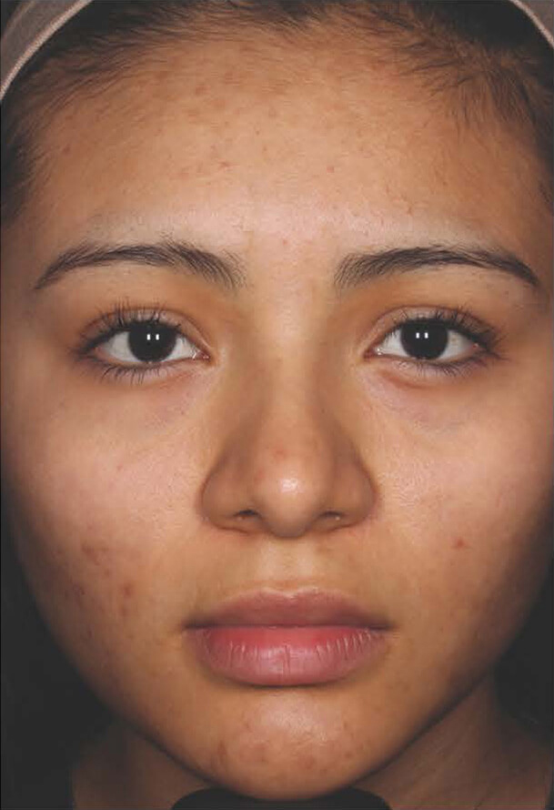 Aczone gel woman patient after photo