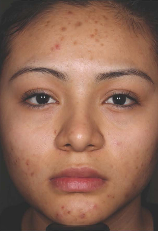 Aczone gel woman patient before photo