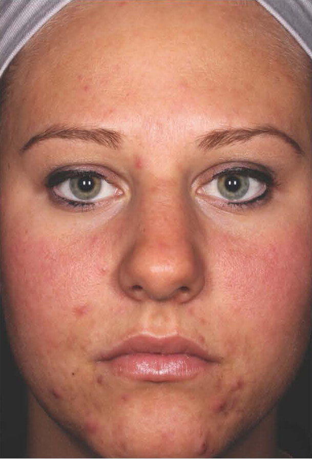Aczone gel woman patient before photo