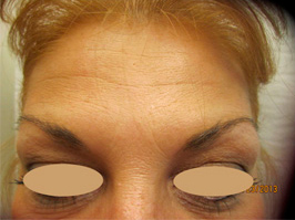Botox Separate Page After