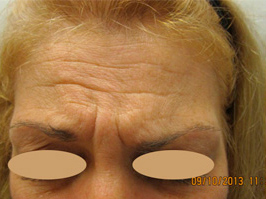 Botox Patient1 Set1 Before