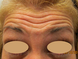 Botox 2 Patient1 Set1 Before Page