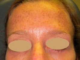 Botox 3 Patient1 Set1 After Page