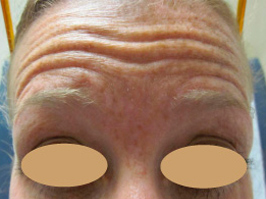 Botox 3 Patient1 Set1 Before