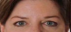 Botox Treatment After Photos 5