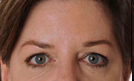 Botox 4 Patient1 Set1 After