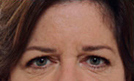 Botox 4 Patient1 Set1 Before