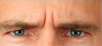 Botox 8 Patient1 Set1 Before