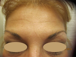Dysport patient after photo