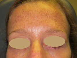 Dysport patient after photo
