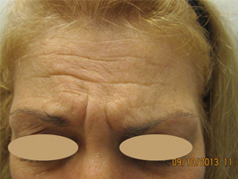 Dysport patient before photo