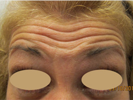 Dysport patient before photo