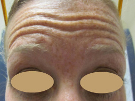 Dysport patient before photo