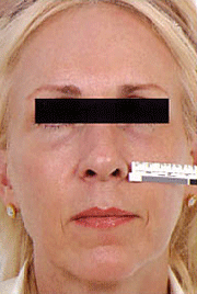 Fraxel patient after photo
