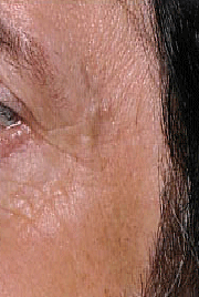 Fraxel patient after photo