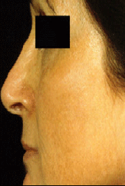 Fraxel patient after photo