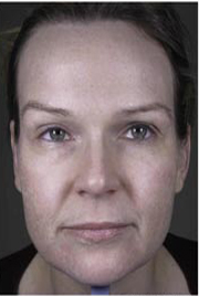 Fraxel patient after photo