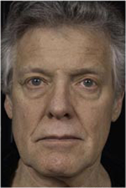 Fraxel patient after photo