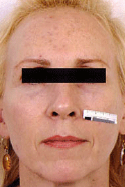 Fraxel patient before photo