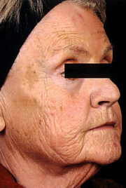 Fraxel patient before photo