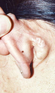 KELOID SCARS patient after photo