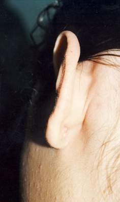 KELOID SCARS patient after photo