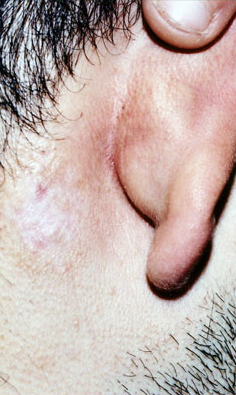 KELOID SCARS patient after photo