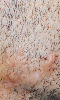 KELOID SCARS patient after photo