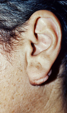 KELOID SCARS patient after photo
