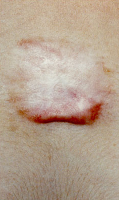KELOID SCARS patient after photo