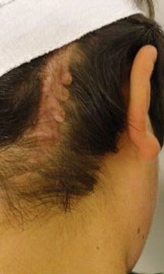 KELOID SCARS patient after photo
