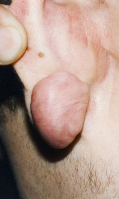 KELOID SCARS patient before photo