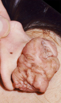 KELOID SCARS patient before photo