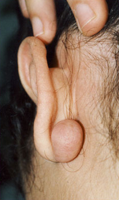 KELOID SCARS patient before photo
