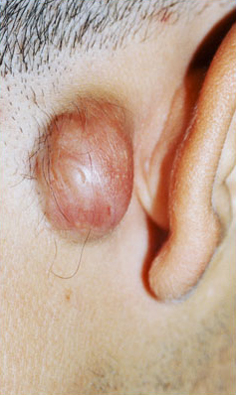 KELOID SCARS patient before photo
