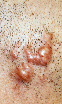 KELOID SCARS patient before photo