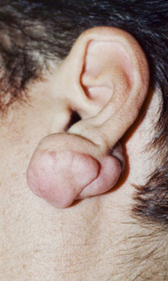 KELOID SCARS patient before photo