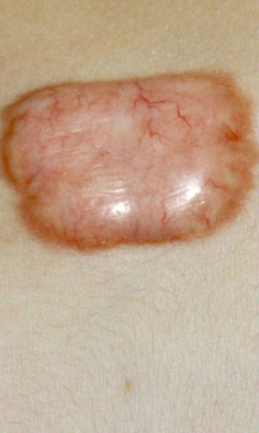 KELOID SCARS patient before photo