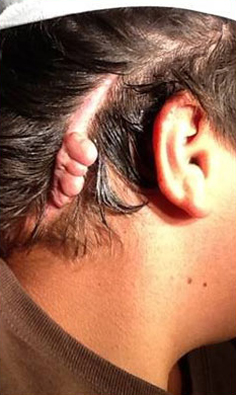 KELOID SCARS patient before photo