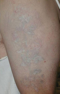 Tattoo removal patient after photo