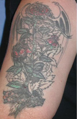 Tattoo removal patient before photo