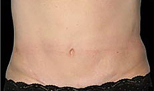 CoolSculpting patient after photo