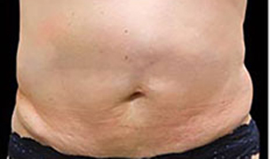 CoolSculpting patient before photo