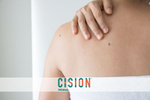 Monitoring Moles: Stay Alert to Stay Safe from Deadly Skin Cancer