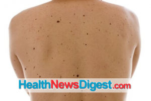 Monitoring Moles: Stay Alert to Stay Safe from Deadly Skin Cancer