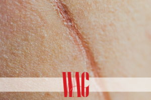LESSENING THE PRESENCE OF SCARS