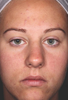 Acne Treatment Patient 1 Patient1 Set1 After
