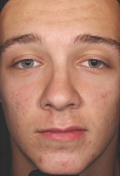 Acne Treatment Patient 2 Patient1 Set1 After