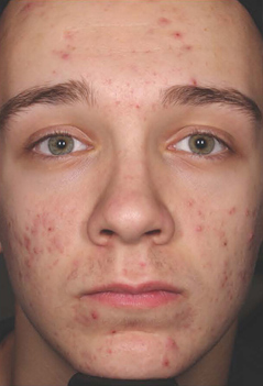 Acne Treatment Patient 2 Patient1 Set1 Before Page