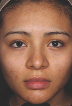 Acne Treatment Patient 3 Patient1 Set1 After